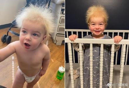 美国男婴患罕见难梳头发综合征：爱因斯坦也患有此病、天生爆炸头