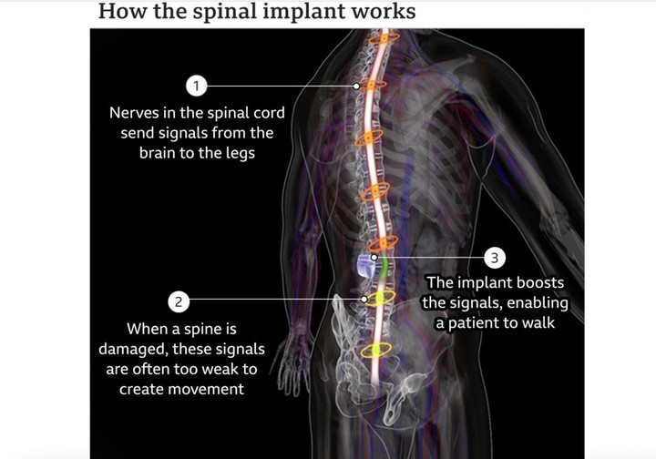 植入物让脊髓被切断的瘫痪患者重新行走，医学上的「奇迹」？