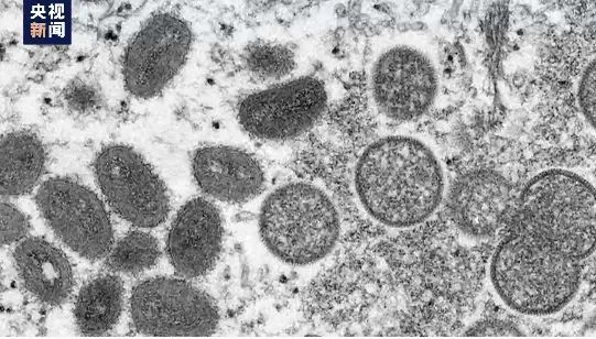 猴痘出现“人传人”！30个国家和地区发现超550例病例 是否会全球大流行？